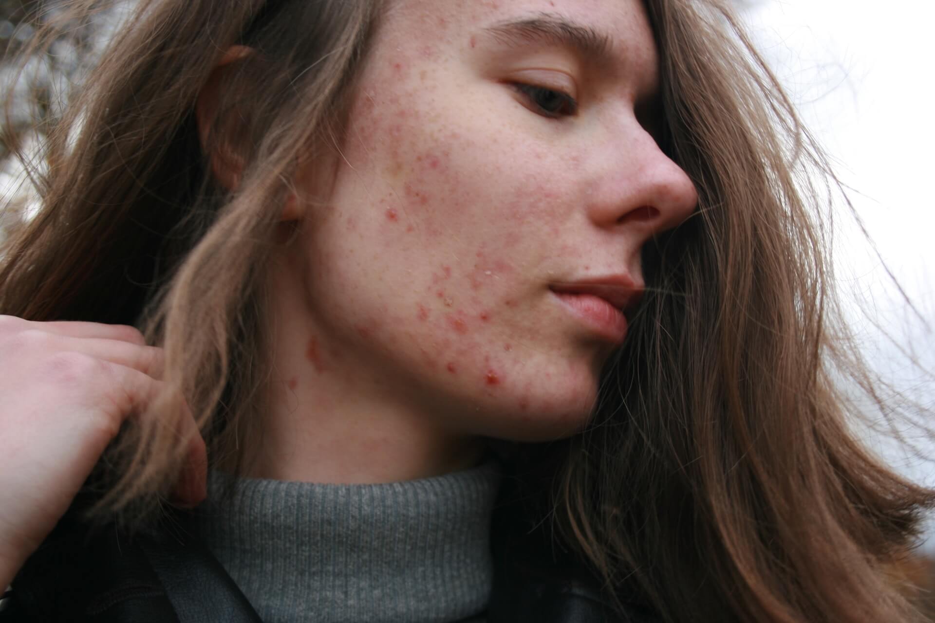 Rostro de mujer con acné